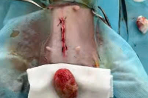 Ca Mỗ Sỏi Bàng Quang Của Bé SuRi