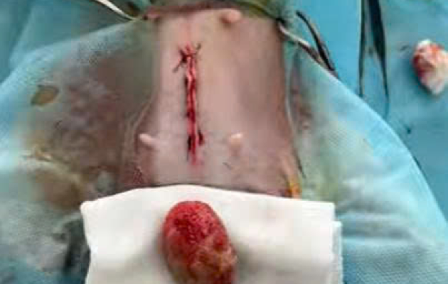 Ca Mỗ Sỏi Bàng Quang Của Bé SuRi